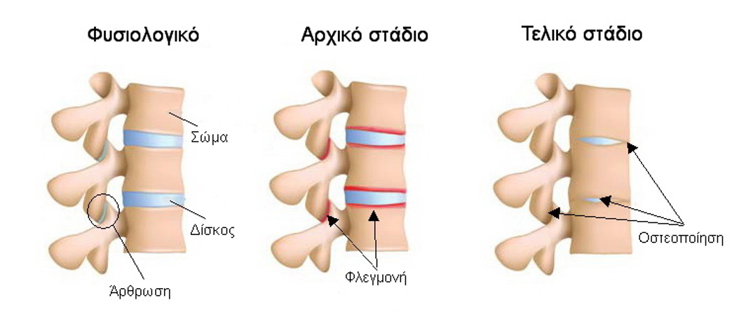 αγκυλοποιητική σπονδυλίτιδα